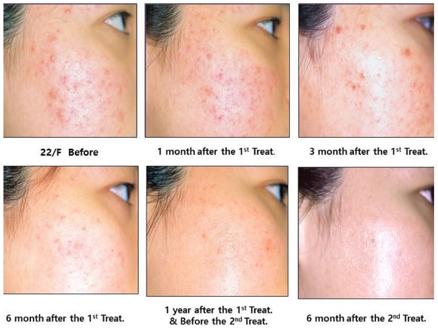 Scarlet RF Microneedling