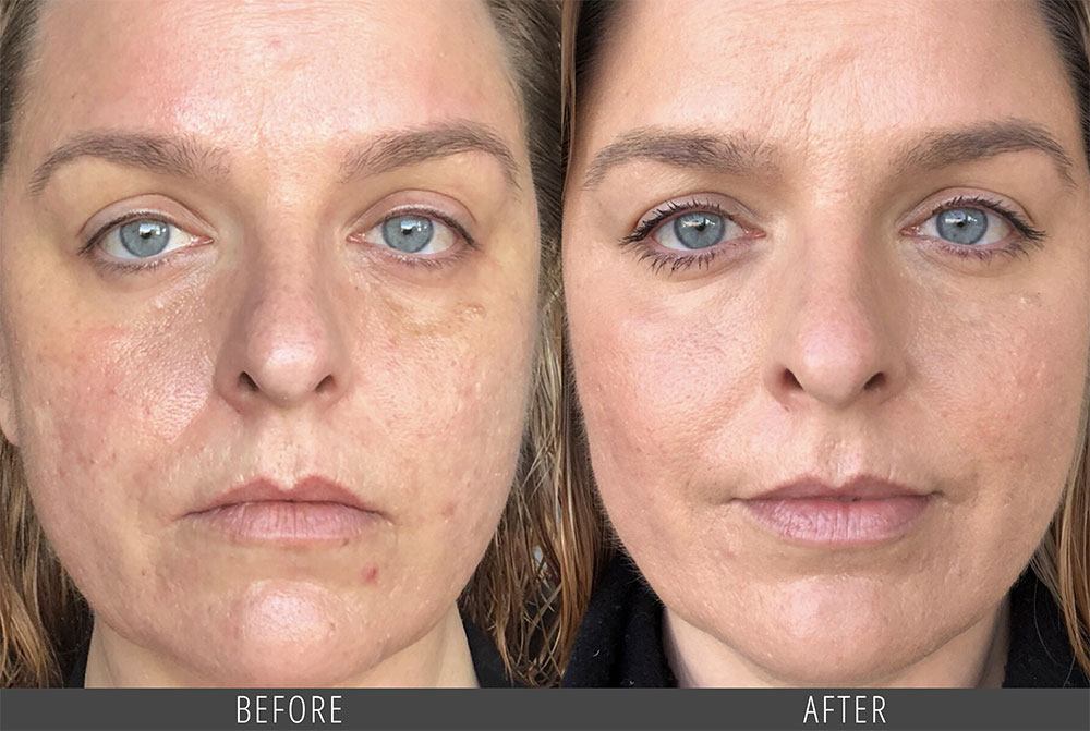 Scarlet RF Microneedling