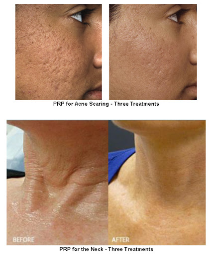 Scarlet RF Microneedling